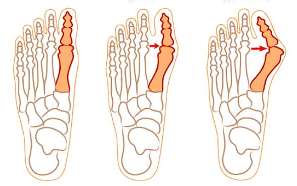 Παραμόρφωση Hallux Valgus