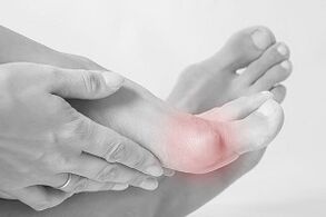 Hallux valgus Πώς να επιλέξετε παπούτσια