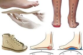 Ορθοπεδικά υποδήματα για χαλουζ βαλγκού σε παιδί