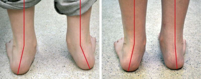 Valgus πόδια