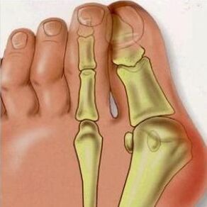 Οι λόγοι για τον Valgus