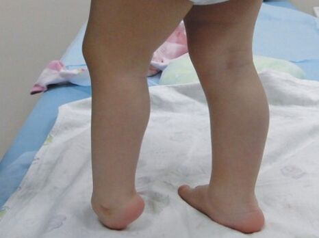Τα πρώτα συμπτώματα της παραμόρφωσης του Valgus του ποδιού