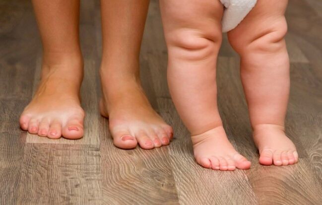 Valgus παραμόρφωση του ποδιού στα παιδιά