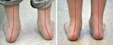 Καμπυλότητα Valgus